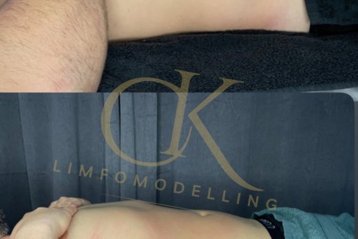 Limfomodelling