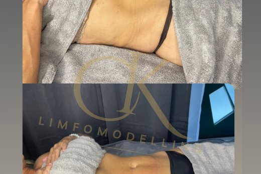 Limfomodelling